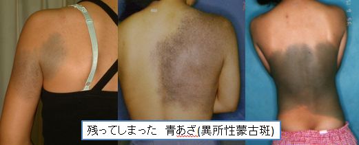 のこってしまったあおあざ WS000000.JPG