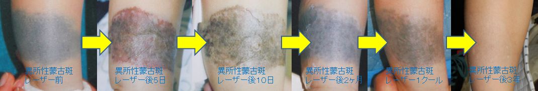 青あざのレーザー経過　やけど　WS000023 (2).JPG