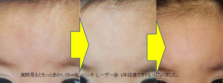 サーモン あかあざ レーザー WS000031 (2).JPG
