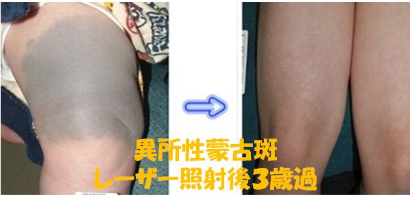 あおあざ ふともも レーザー WS000033 (2).JPG