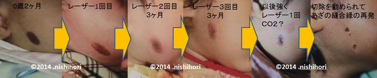 ちゃあざさいはつ レーザー オペ 再発 WS000040.JPG