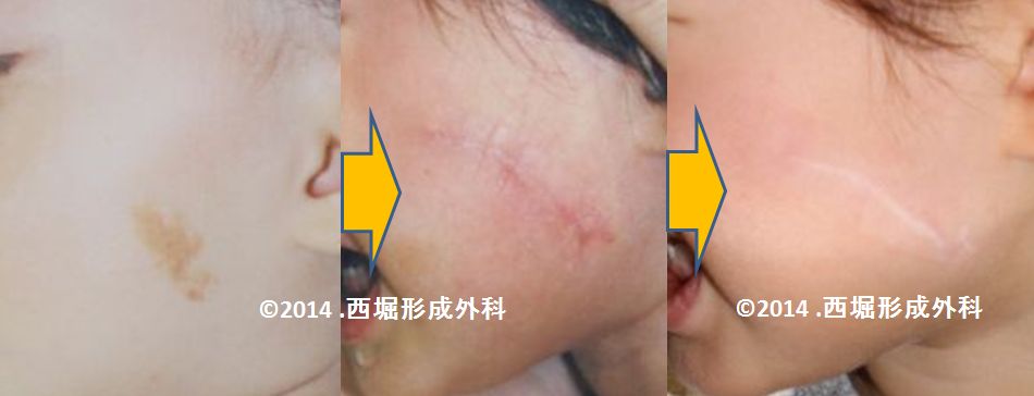 茶あざ　切除　左頬　WS000045 (2).JPG